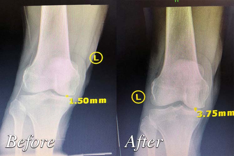 photo of Before and after treatment by Granite Bay Advanced Joint Pain Relief Solutions